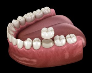 Illustration of a dental crown being placed on a molar in the lower jaw