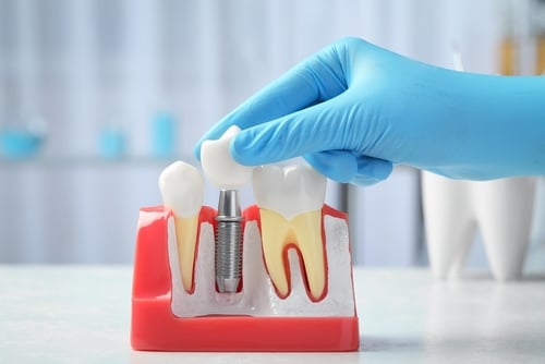 Gloved hand placing a dental implant into a dental model